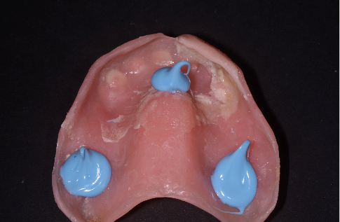 Salcetti 8 considerations denture relining 01 1