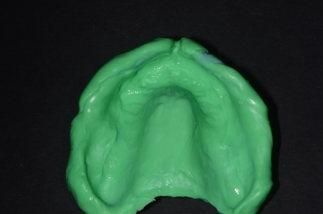 salcetti 8 considerations denture relining 010