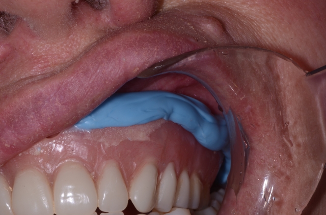 salcetti 8 considerations denture relining 04