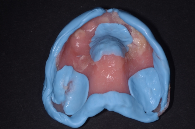 salcetti 8 considerations denture relining 05