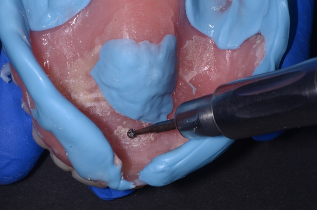 salcetti 8 considerations denture relining 06