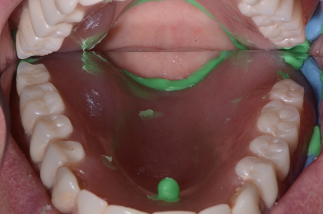 salcetti 8 considerations denture relining 07