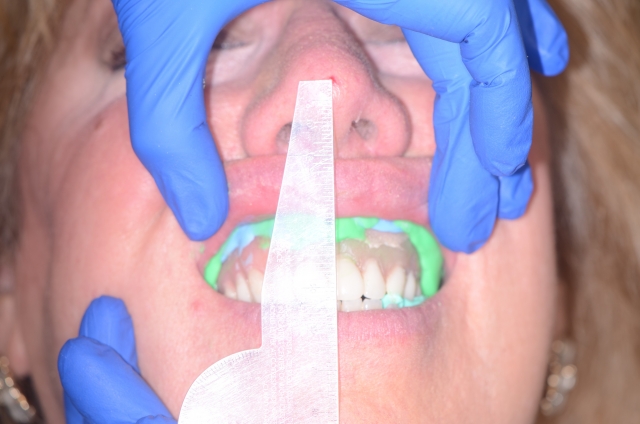 salcetti 8 considerations denture relining 09