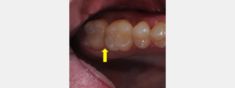 Simple In-Office Technique for Closing Open Molar Contacts Bonk simple in office techniques open molar 01