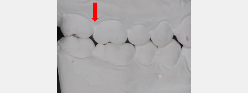 Simple In-Office Technique for Closing Open Molar Contacts Bonk simple in office techniques open molar 02