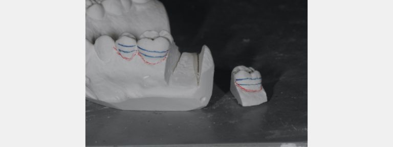 Simple In-Office Technique for Closing Open Molar Contacts