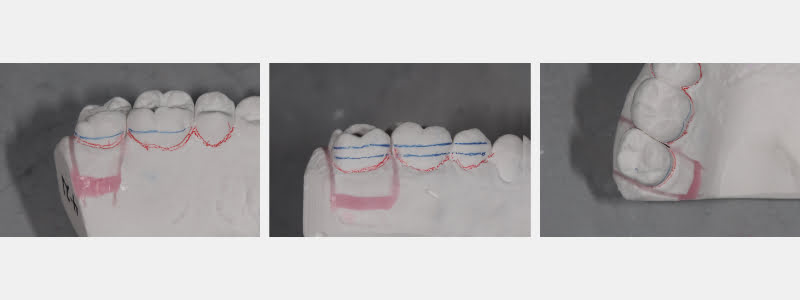 Simple In-Office Technique for Closing Open Molar Contacts Bonk simple in office techniques open molar 04