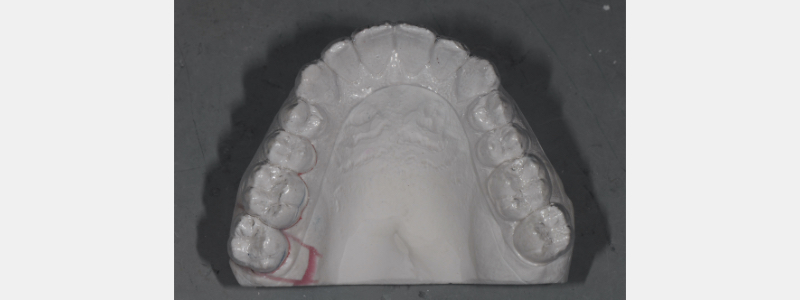 Simple In-Office Technique for Closing Open Molar Contacts Bonk simple in office techniques open molar 05