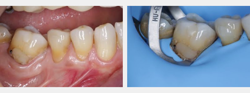 Use a 212 Modified Clamp to Restore Cervical Carious & NCCLs on Adjacent Teeth Guerrero using 212 modified clamp 04