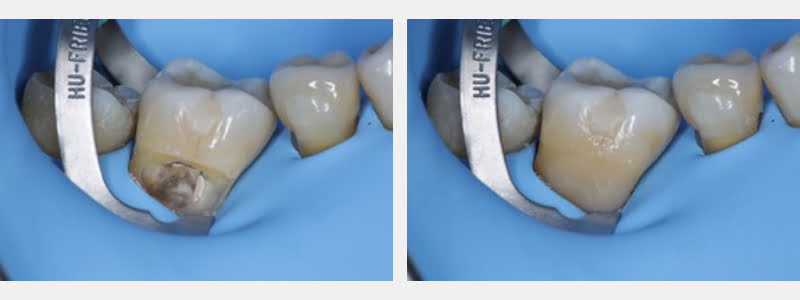 Use a 212 Modified Clamp to Restore Cervical Carious & NCCLs on Adjacent Teeth Guerrero using 212 modified clamp 05