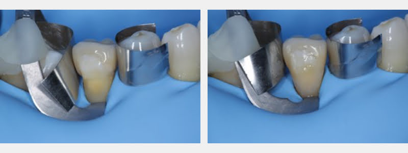 Use a 212 Modified Clamp to Restore Cervical Carious & NCCLs on Adjacent Teeth Guerrero using 212 modified clamp 06