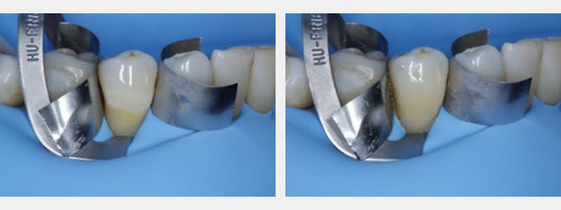 Use a 212 Modified Clamp to Restore Cervical Carious & NCCLs on Adjacent Teeth Guerrero using 212 modified clamp 07