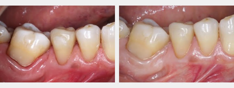 Use a 212 Modified Clamp to Restore Cervical Carious & NCCLs on Adjacent Teeth Guerrero using 212 modified clamp 08