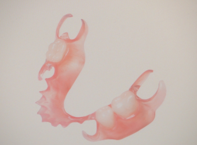 The Pros and Cons of Thermoplastic Partial Dentures Salcetti pros cons thermoplastic partial 01