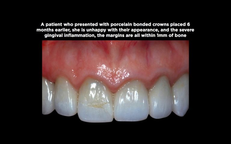 A Comprehensive Guide To Biologic Width