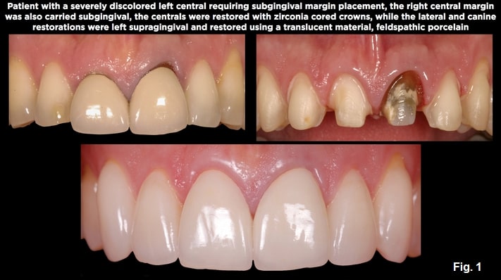 Spear comprehensive guide biologic width 03 1