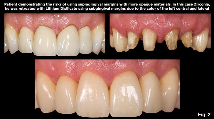 Spear comprehensive guide biologic width 04
