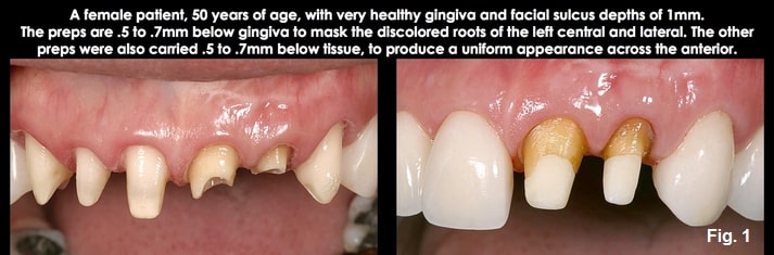 Spear comprehensive guide biologic width 06
