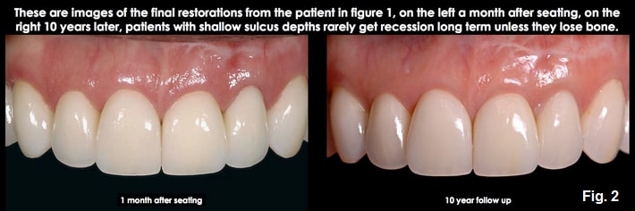 Spear comprehensive guide biologic width 07 2