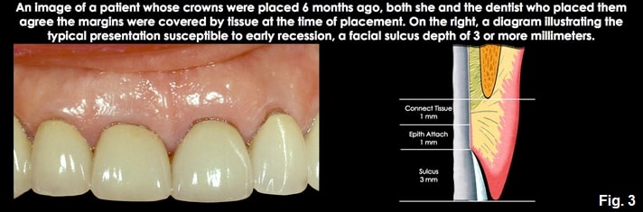 Spear comprehensive guide biologic width 08
