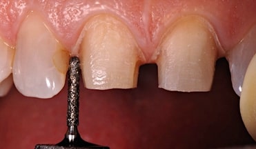 Spear comprehensive guide biologic width 10