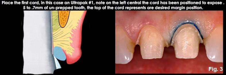 Spear comprehensive guide biologic width 13