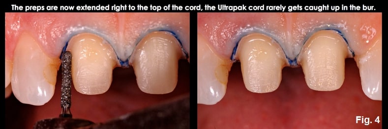 Spear comprehensive guide biologic width 14