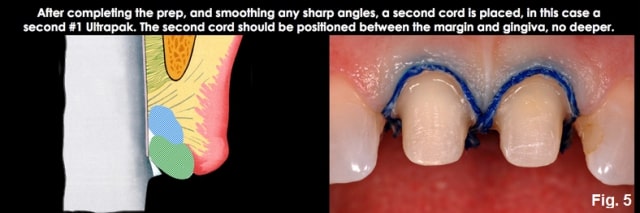 Spear comprehensive guide biologic width 15