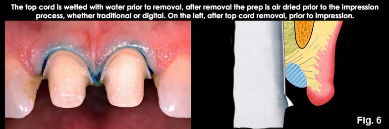 Spear comprehensive guide biologic width 16