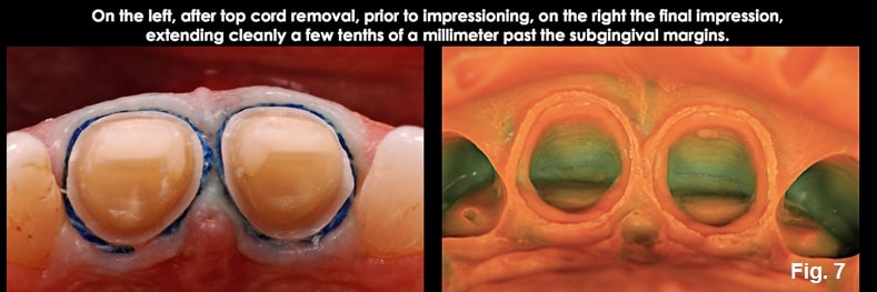 Spear comprehensive guide biologic width 17