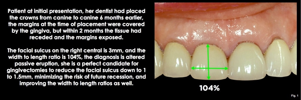 Spear comprehensive guide biologic width 19