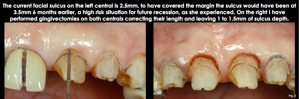 Spear comprehensive guide biologic width 20