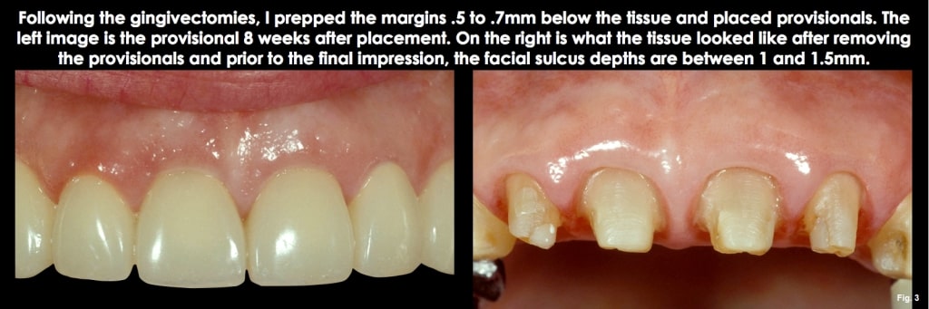 Spear comprehensive guide biologic width 21