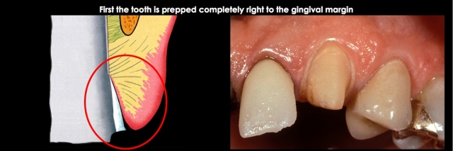 Spear comprehensive guide biologic width 25