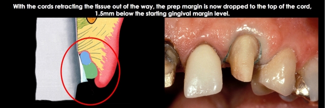 Spear comprehensive guide biologic width 27 1