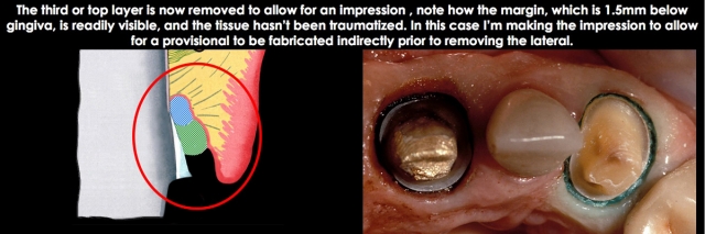 Spear comprehensive guide biologic width 29