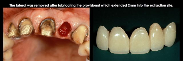 Spear comprehensive guide biologic width 30
