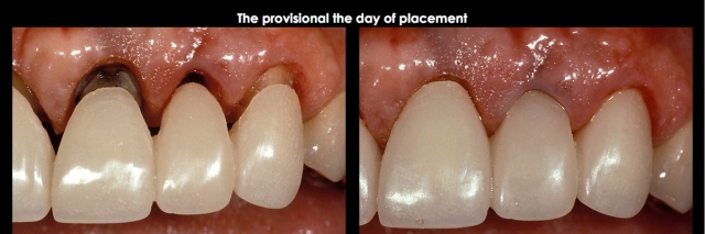 Spear comprehensive guide biologic width 31 1