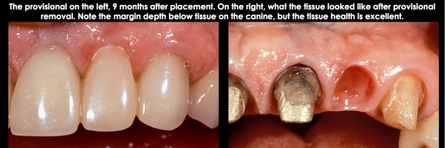 Spear comprehensive guide biologic width 32