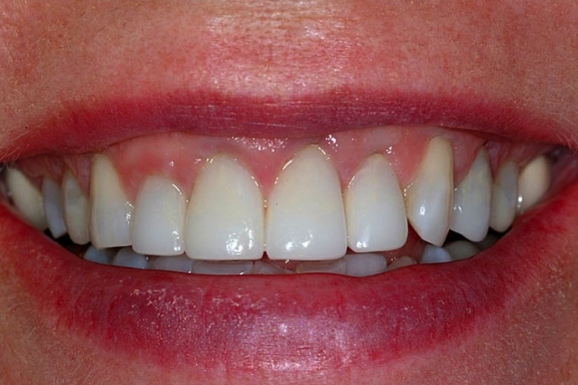 Spear comprehensive guide biologic width 33