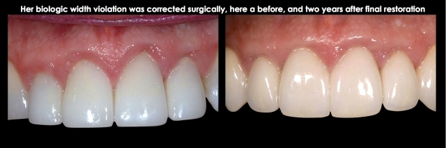 Spear comprehensive guide biologic width 35