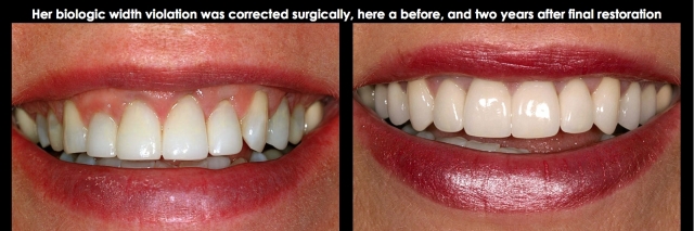 Spear comprehensive guide biologic width 36