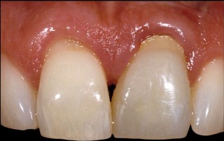 Spear comprehensive guide biologic width 37