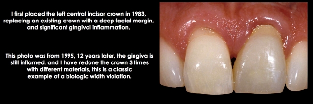 Spear comprehensive guide biologic width 38