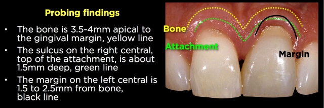 Spear comprehensive guide biologic width 40