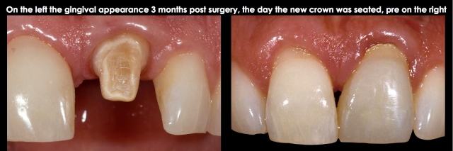 Spear comprehensive guide biologic width 42 1