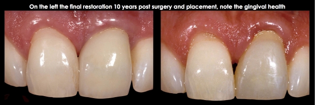 Spear comprehensive guide biologic width 43
