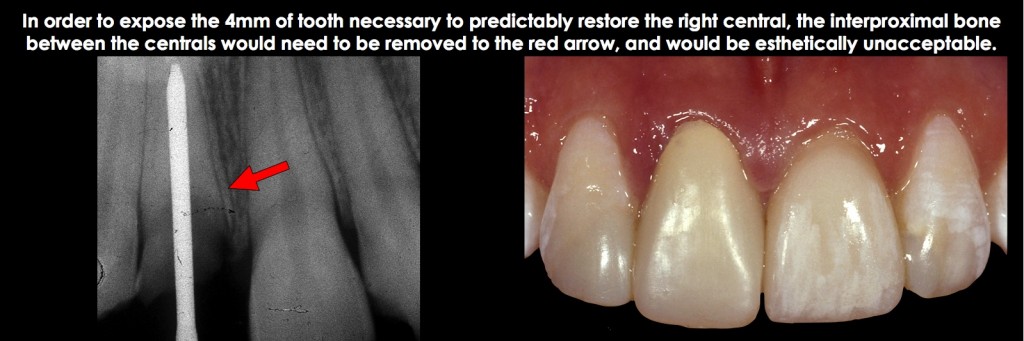Spear comprehensive guide biologic width 45
