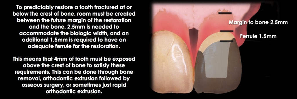 Spear comprehensive guide biologic width 46