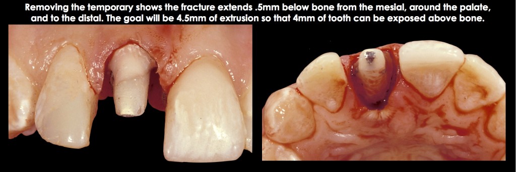 Spear comprehensive guide biologic width 47